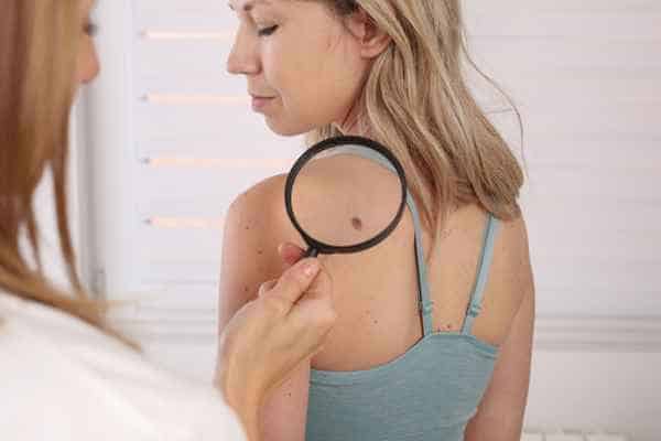 What Are Traditional Skin Lesion Removal Methods Oxfordshire?
