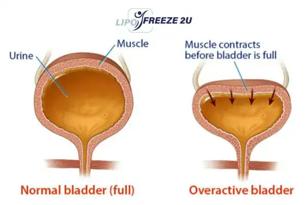 diagram of overactive bladder treatment Oxfordshire