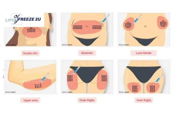 Benefits of Choosing Aqualyx for Fat Reduction Oxfordshire
