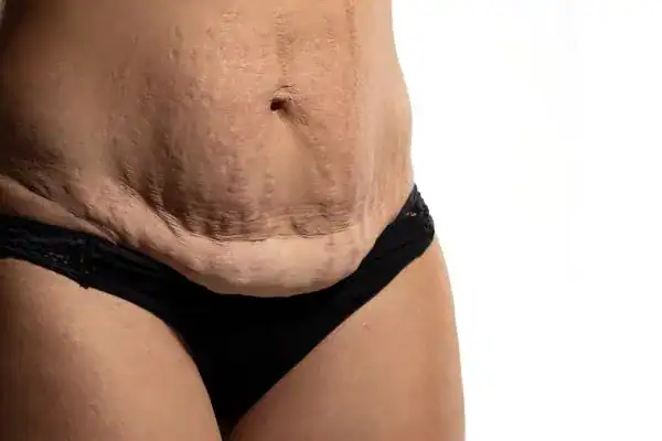 loose skin after weight loss injections Oxfordshire