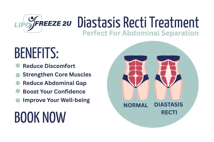 How Long Will It Take to See Improvements in Diastasis Recti Oxfordshire