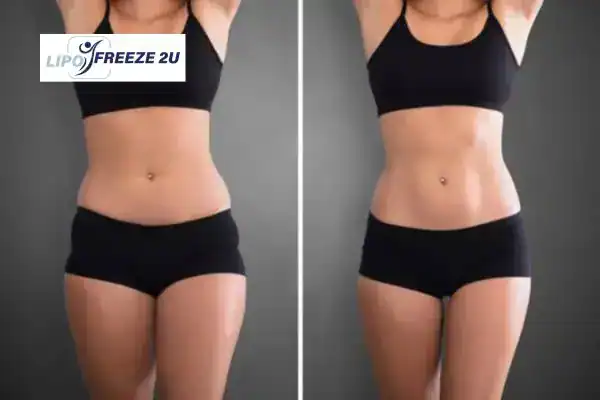 How Can LIPO FREEZE 2U Support Your Post-Pregnancy Body Recovery Oxfordshire?