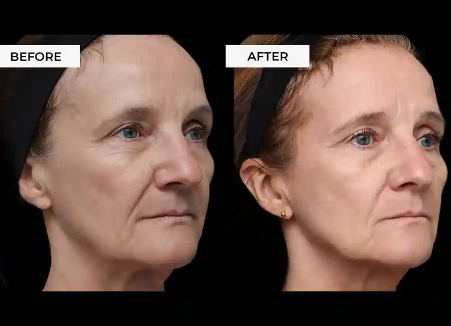 How Many RF Microneedling Sessions Will You Need to See a Difference Oxfordshire?