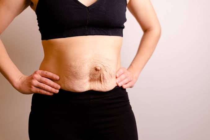 Is Surgery Really the Only Way to Repair Diastasis Recti Oxfordshire?