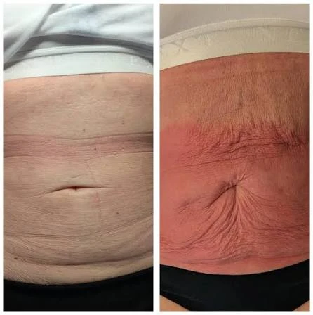 How Does RF Microneedling Improve Crepey, Thin and Uneven Skin Texture Oxfordshire?