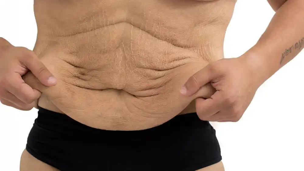 Why Does Weight Loss Medication Leave Some People With Loose or Sagging Skin Oxfordshire?